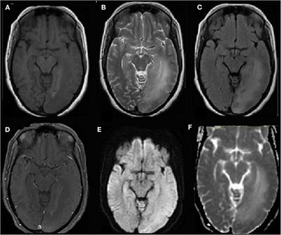 Neurological Associations of COVID-19—Do We Know Enough: A Tertiary Care Hospital Based Study